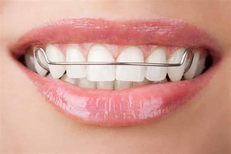 Post Orthodontic Care Guide South Bay Dentistry And Orthodontics