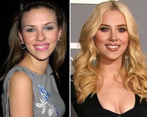 Scarlett Johansson Nose Job Plastic Surgery Before And After Celebie