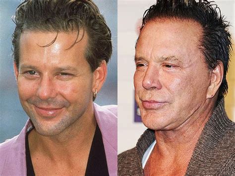 Mickey Rourke Plastic Surgery Before And After Photos