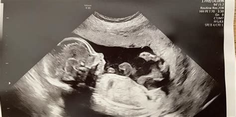Ultrasound Gender Predictions Please In Ultrasound Gender Prediction Forum