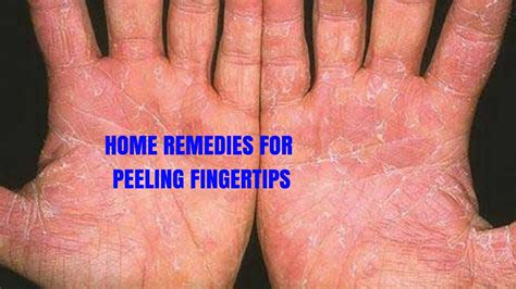 Home Remedies For Peeling Fingertips Youtube