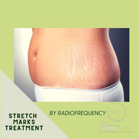 Stretch Marks Treatment By Secret Radiofrequency علاج علامات التمدد بالترددات الراديوية The