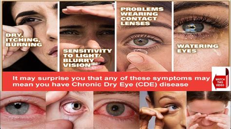 Read about dry eyes (dry eye syndrome, keratoconjunctivitis sicca). DRY EYE SYNDROME | PATIENT EDUCATION AND INFORMATION ...