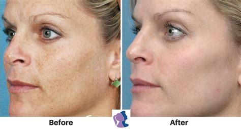 Photofacial Light Based Intense Skincare Treatment Fda Approved