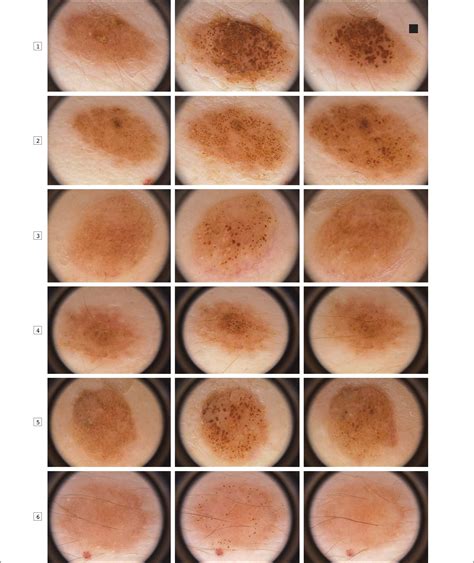 Dermatoscopic Changes In Acquired Melanocytic Nevi And Seborrheic