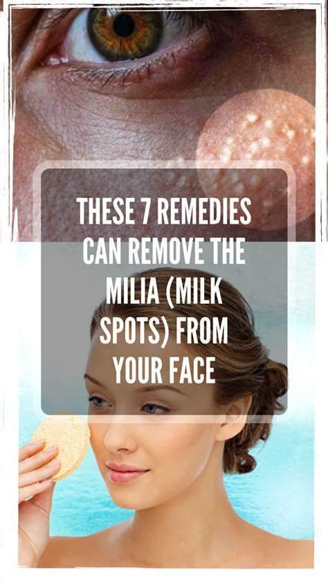 These 7 Remedies Can Remove The Milia Milk Spots From Your Face R
