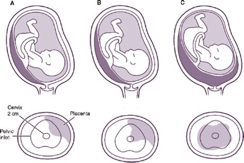 third trimester vaginal bleeding current diagnosis and treatment obstetrics and gynecology 11th ed