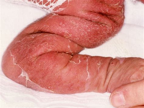 Staphylococcal Scalded Skin Syndrome Ssss