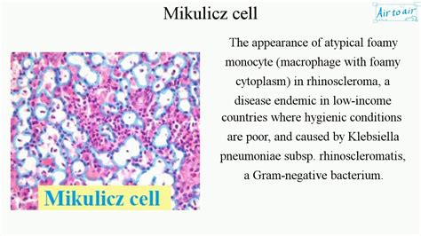 Mikulicz Cell English Medical Terminology For Medical Students