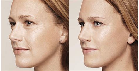 Botox en la cara antes y después. Ácido hialurónico de Galderma, probado en gemelas ...