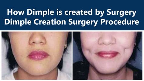 See How Dimple Is Created By Dimple Creation Surgery The Esthetic Clinics India Youtube