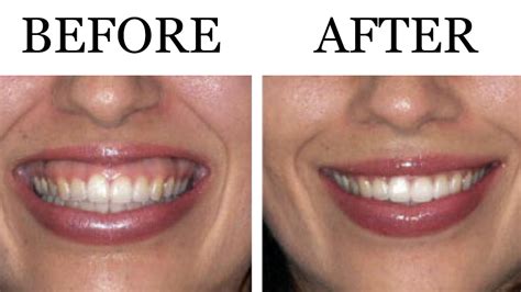 Gummy Smile Botox Lifestyle Solutions