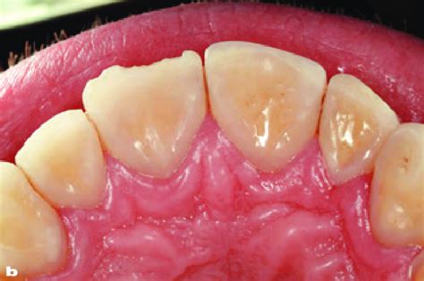 A Due To The Patients Nail Biting Habit The Incisal Edge Of One The