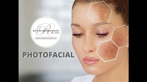 Ipl Photofacial Treatment Before And After Youtube