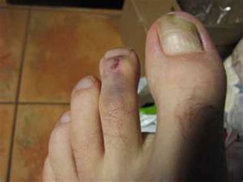 For a minor fracture, realignment of bones might not be necessary and treatment typically. Symptoms You Have a Broken Pinky Toe or Stubbed Toe ...