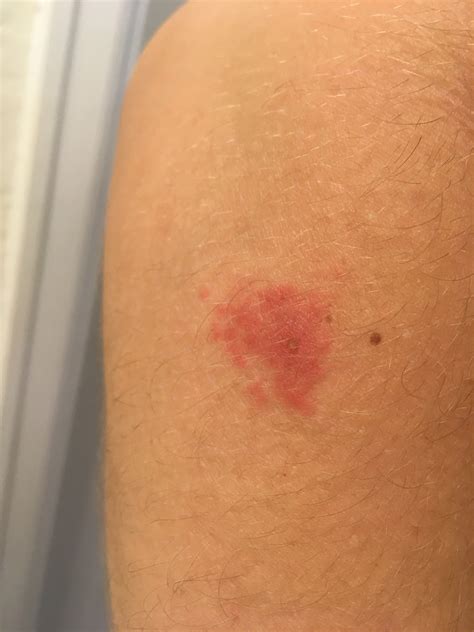 Red Spots On Skin Not Itchy Causes Treatments Home Vrogue Co
