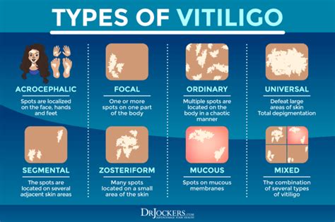 Vitiligo Symptoms Causes And Support Strategies