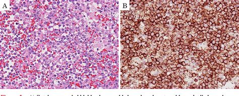 Figure 3 From Primary Cardiac Diffuse Large B Cell Lymphoma Promptly
