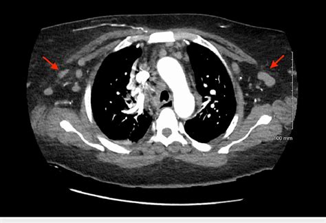 Ct Pulmonary Angiography Showing Bilateral Axillary Lymphadenopathy