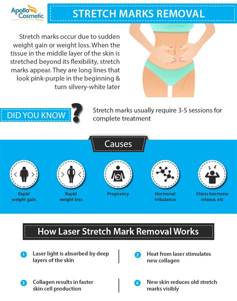 Laser Stretch Marks Removal In Chennai Apollo Cosmetic Clinics
