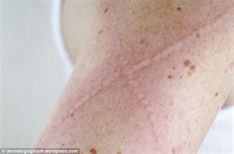 Little White Bumps On Skin Pictures Photos
