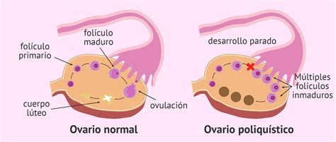 Síndrome del ovario poliquístico SOP Ginecología y Obstetricia