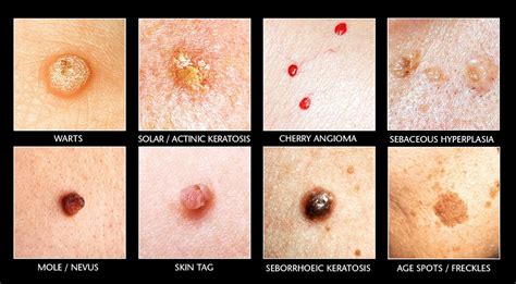 Skin Growth Removal Waxed And Skin Ste 16 At Sola Salons 1940 W