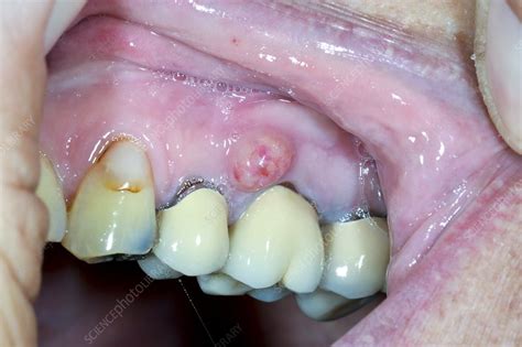 Dental Sinus Stock Image C0269215 Science Photo Library