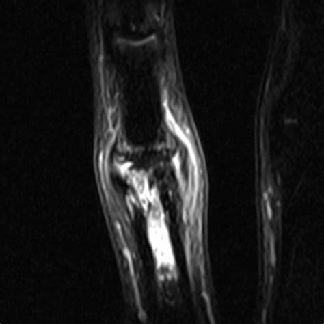 Radiologia Do Esporte Ruptura Completa Do Ligamento Colateral Ulnar