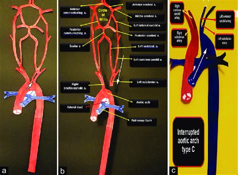 Aortic Arch And Cerebrovascular Circulation In Three Different