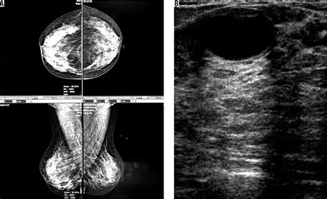 How Can Additional Ultrasonography Screening Improve The Detection Of