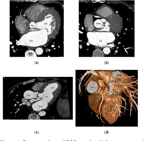 Figure 5 From Native Aortic Valve Endocarditis Complicated By Splenic