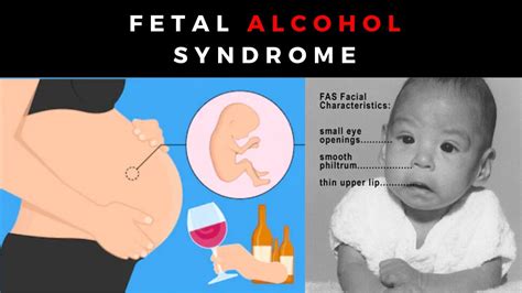 Fetal Alcohol Syndrome Presentation