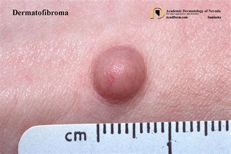 Dermatofibroma Benign Fibrous Histiocytoma Academic Dermatology Of Nevada