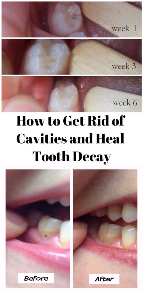 How To Get Rid Of Cavities And Heal Tooth Decay Health And Beauty Queen