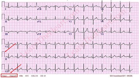 Como Interpretar Um Ecg
