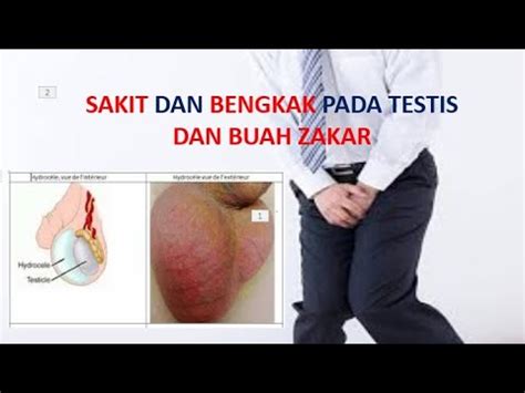 SAKIT DAN BENGKAK PADA TESTIS DAN BUAH ZAKAR YouTube