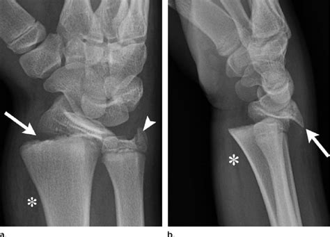 Salter-Harris type I fracture of the distal radius in a ...