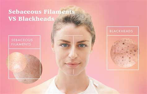 Sebaceous Filaments Vs Blackheads How To Get Rid Of Them