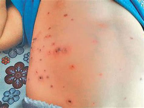 Scrub Typhus disease in Noklak district of Nagaland
