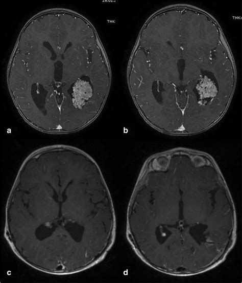 A And B The Intraventricular Tumor Choroid Plexus Papilloma At The