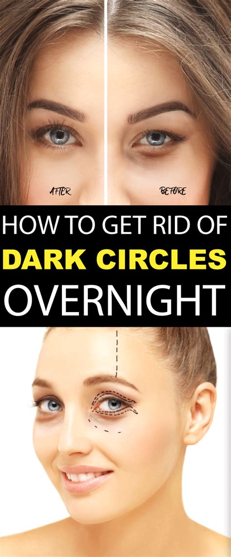 How To Get Rid Of Dark Circles Easily The Most Effective Remedies For