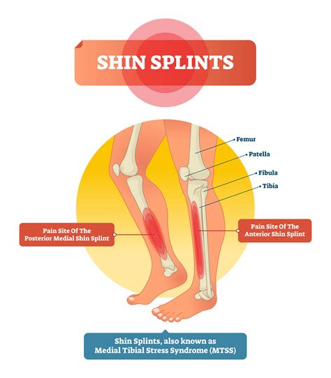 Medial Tibial Stress Syndrome Shin Splints Best Solutions