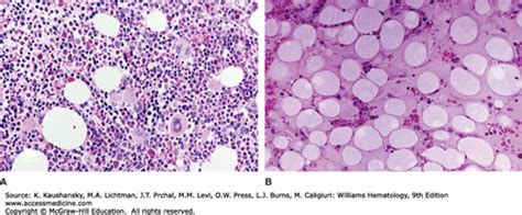 Aplastic Anemia Acquired And Inherited Oncohema Key