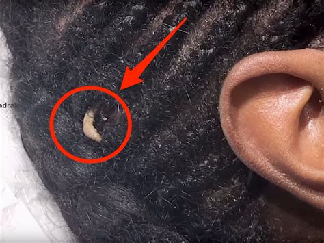 Video Dr Pimple Popper Found A Strange Growth On Her Patients Head