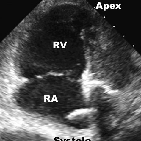 Echocargiographic Still Of Mcconnells Sign Rv Akinesis With Sparing