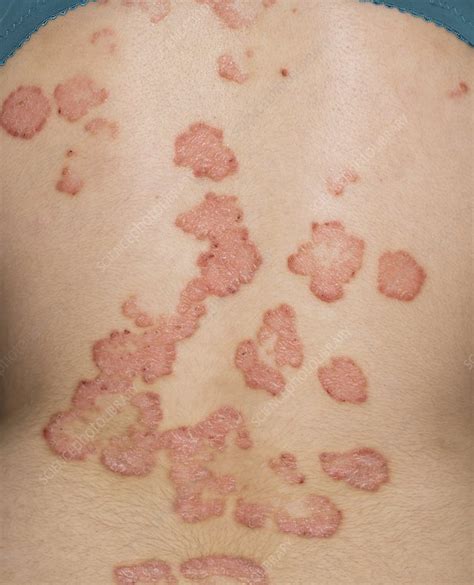 Psoriasis On The Back Before Treatment Stock Image C0142541