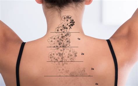 If the skin already has irregularities such as scarring expect that to remain after laser tattoo removal. Laser Tattoo Removal | Cosmetic Laser Center of Wisconsin