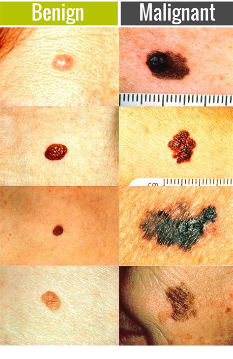 Skin Cancer Misdiagnosis Claims Bolt Burdon Kemp Solicitors