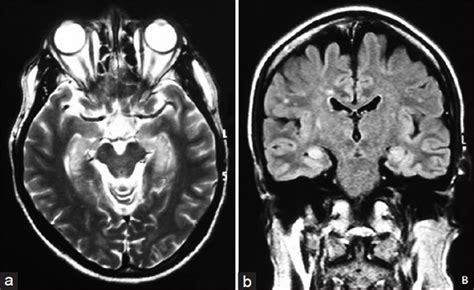 Infection of brain parenchyma of the temporal lobes and inferior frontal lobe causing distinct neurologic abnormality. Limbic Encephalitis - Causes, Symptoms, Diagnosis, Treatment
